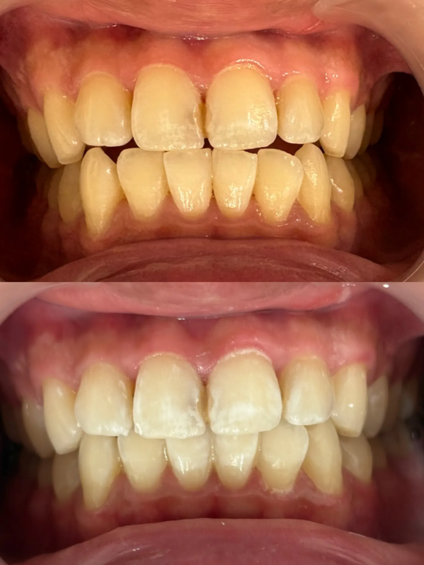 オフィスホワイトニング 1回