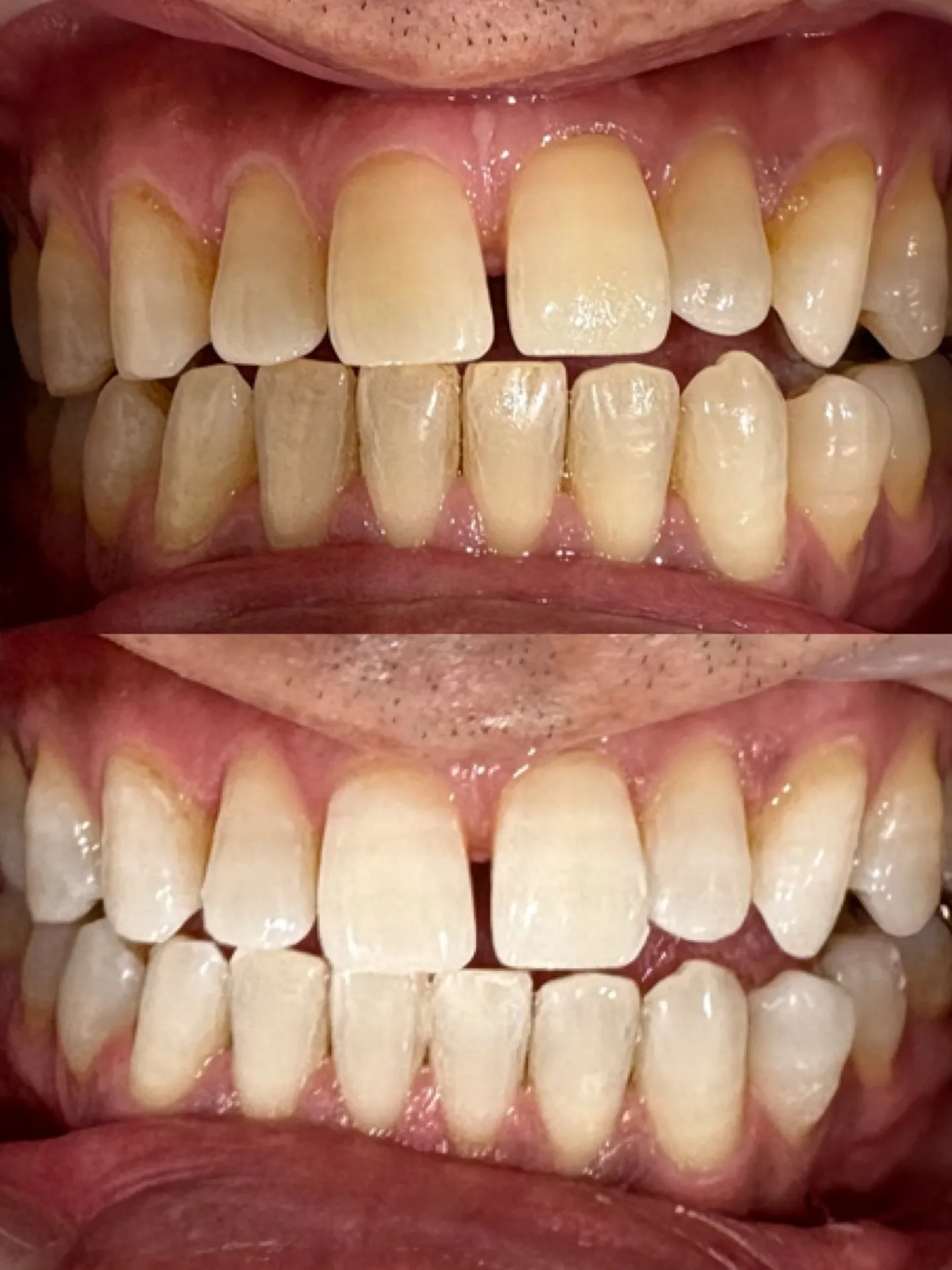 オフィスホワイトニング 1回