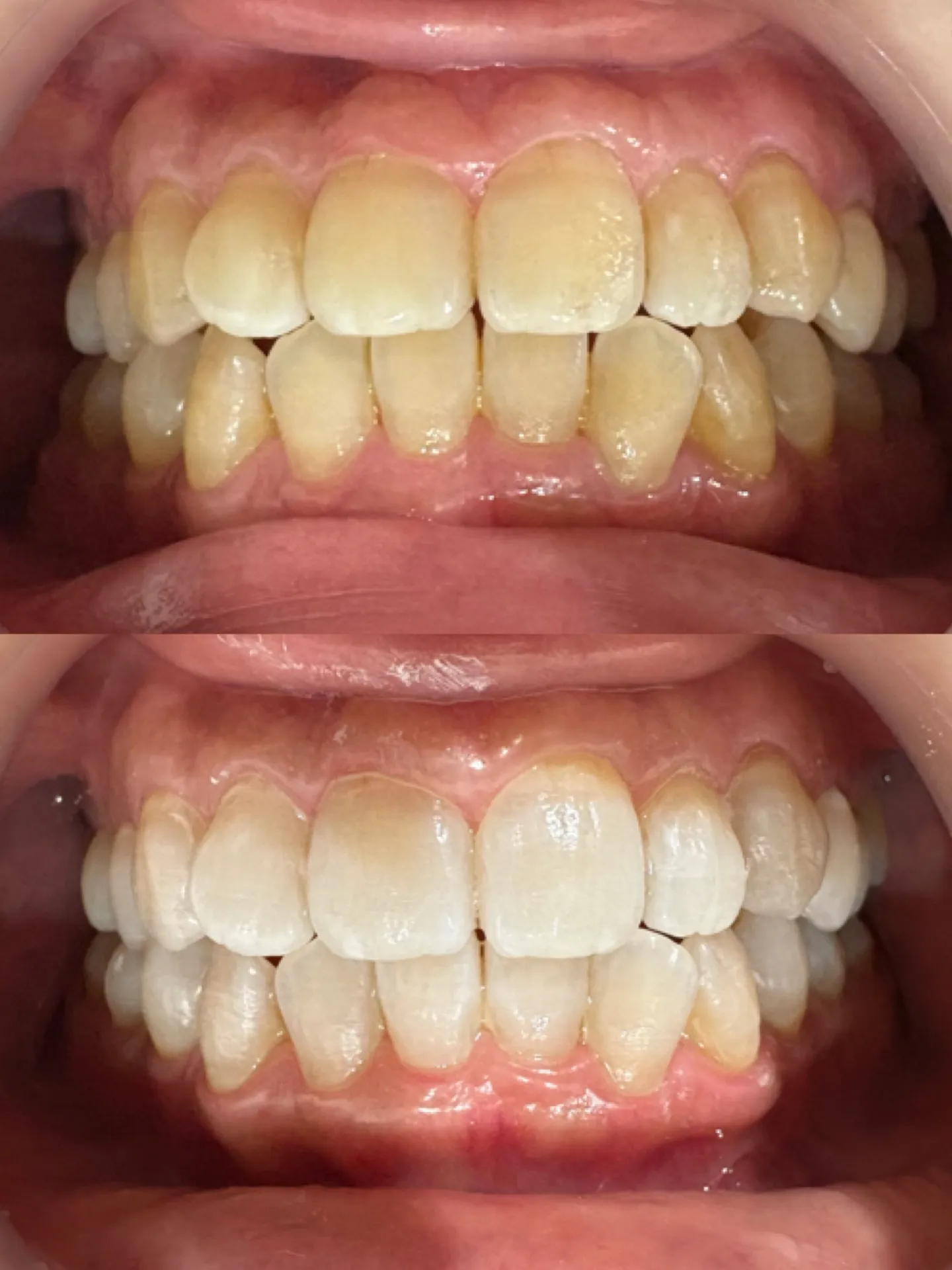 オフィスホワイトニング 1回