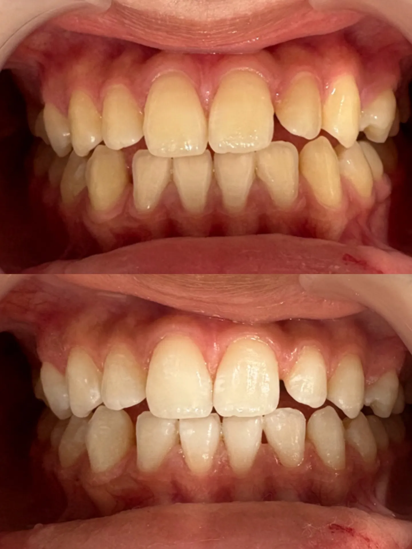 オフィスホワイトニング 1回