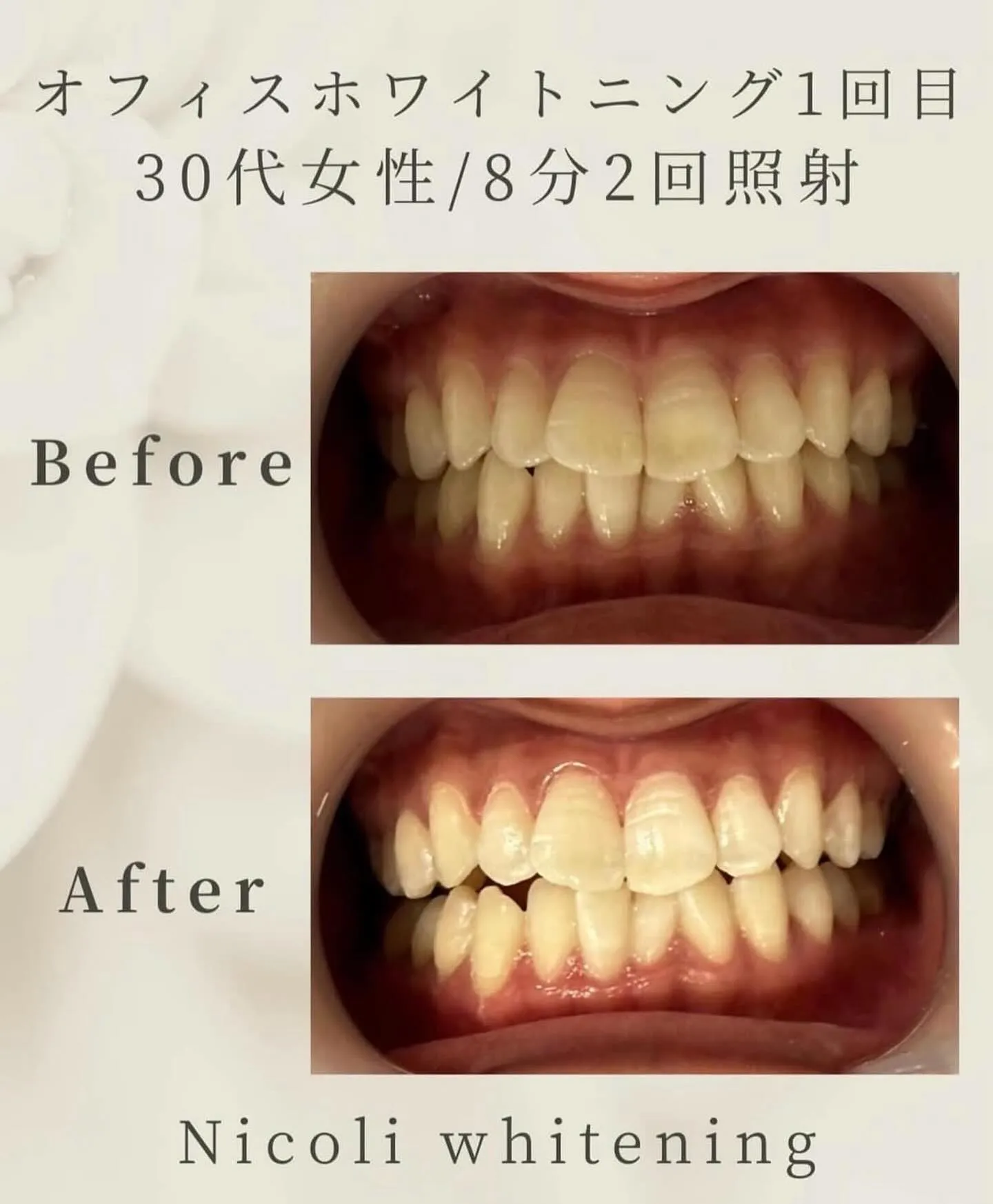 オフィスホワイトニング1回目のお客様です🌟