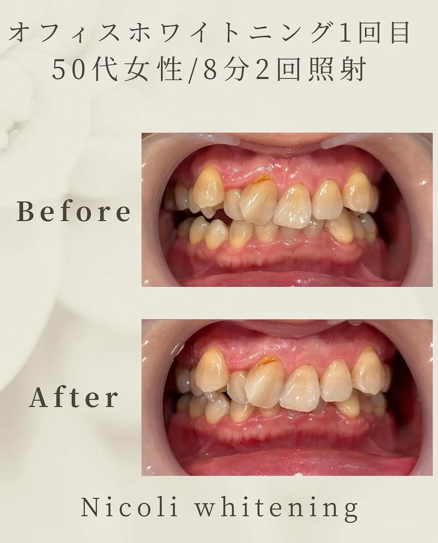 オフィスホワイトニング1回目のお客様です🌟